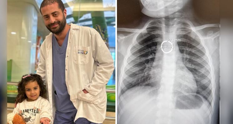 "הלל יפה": בת 3 בלעה את הטבעת של אמה ונאלצה לעבור ניתוח חירום